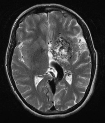 intracranial haemorrhages - AVM