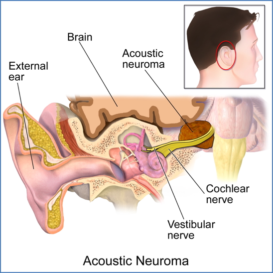 Acoustic Neuroma