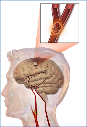 Thrombotic Disorders - Arterial Thrombosis