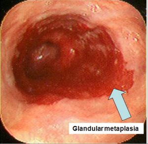 gastro-oesophageal reflux disease - BARRETT’S OESOPHAGUS