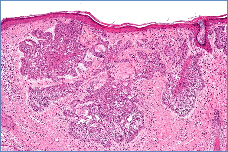 BASAL CELL CARCINOMA