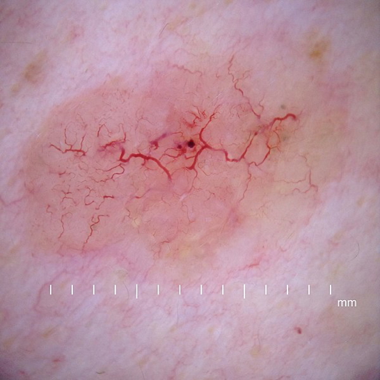 BASAL CELL CARCINOMA