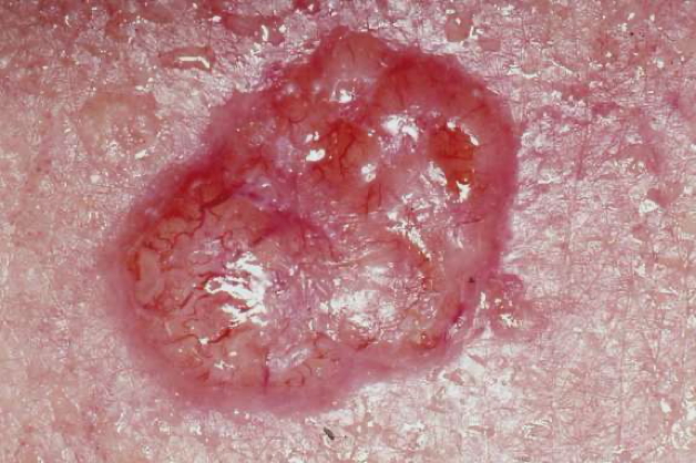 BASAL CELL CARCINOMA