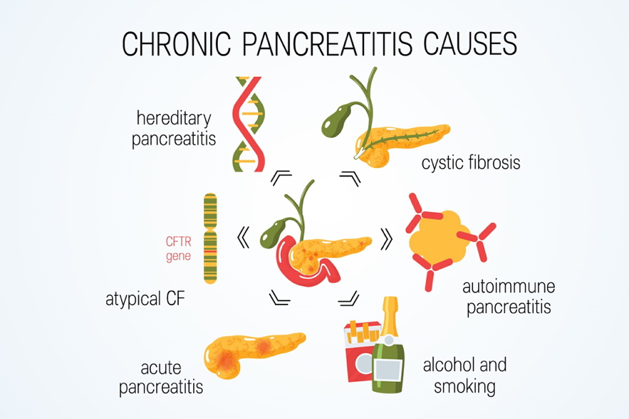 CHRONIC PANCREATITIS