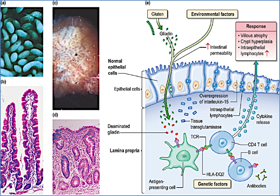 COELIAC DISEASE