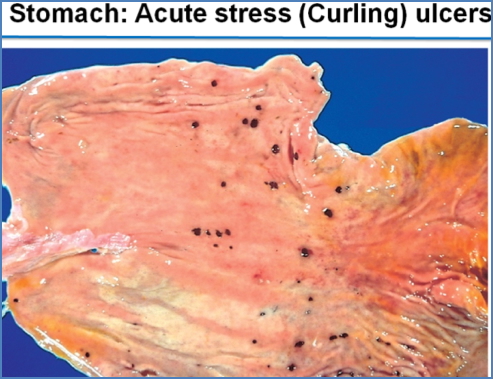 CURLING’S ULCER
