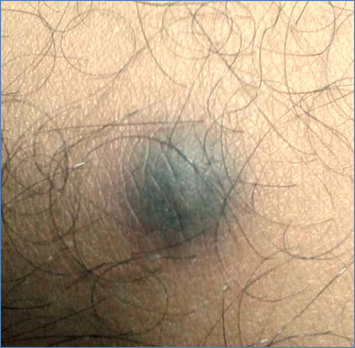 benign fibrous lesions - DERMATOFIBROMA