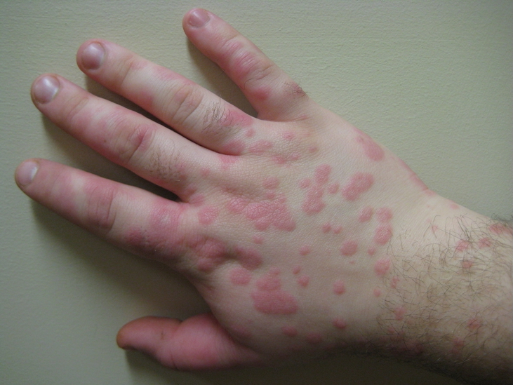 ERYTHEMA MULTIFORME