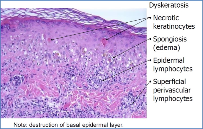 ERYTHEMA MULTIFORME