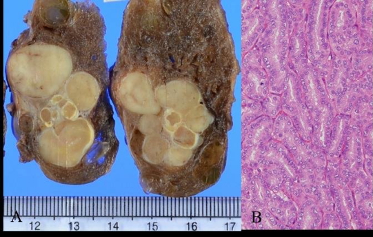 FOLLICULAR CARCINOMA