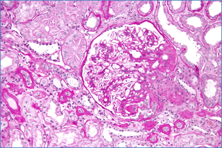 FSGS – FOCAL SEGMENTAL GLOMERULOSCLEROSIS
