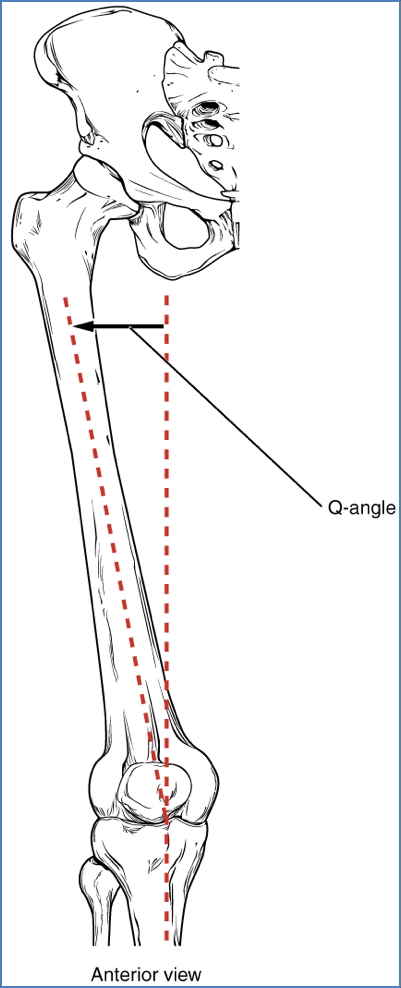 Femur sits on an angle