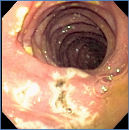 GASTRINOMA Zollinger-Ellison Syndrome