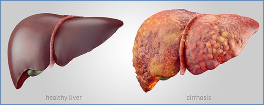 liver failure and cirrhosis