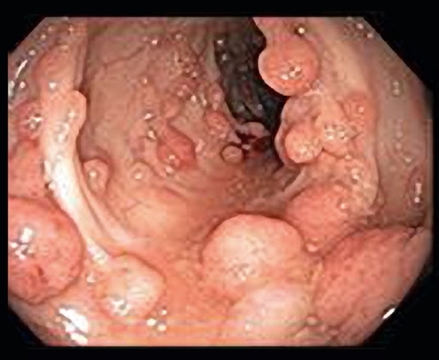 HERIDITARY NON-POLYPOSIS COLON CANCER