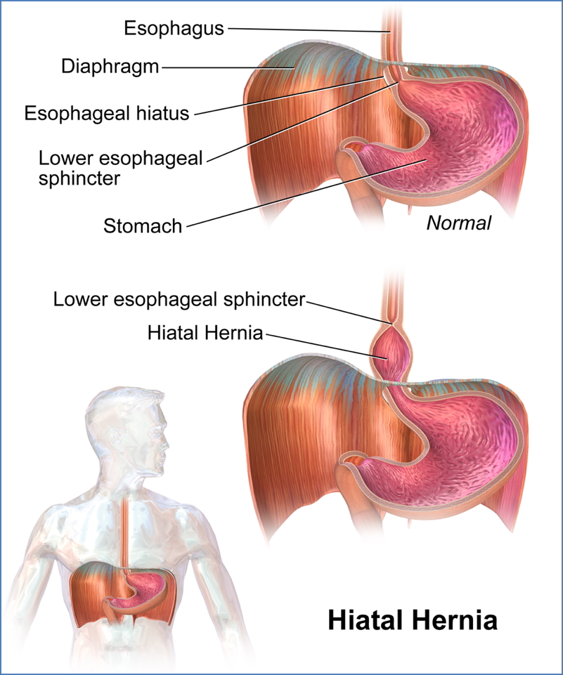 HIATUS HERNIA