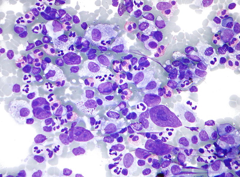 HODGKIN’S LYMPHOMA