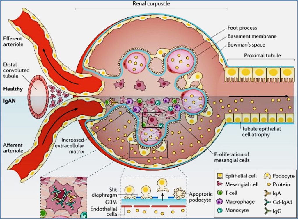 IGA NEPHROPATHY