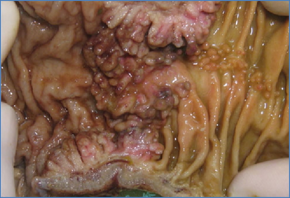 polyps & colon cancer - INFLAMMATORY POLYPS