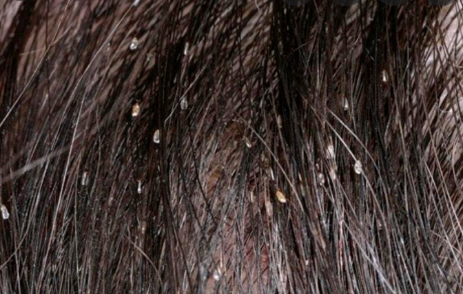 parasitic skin infestations - LICE