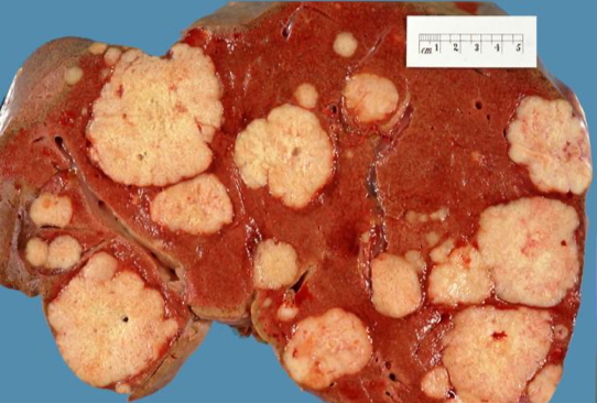 LIVER cancers - METASTASES