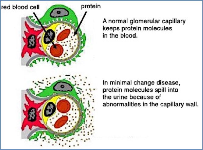 MCD – MINIMAL CHANGE DISEASE