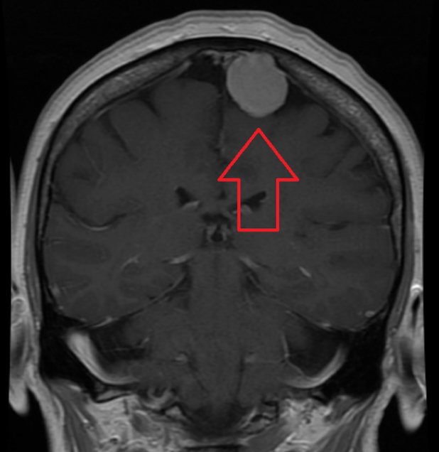 brain tumours - MENINGIOMAS