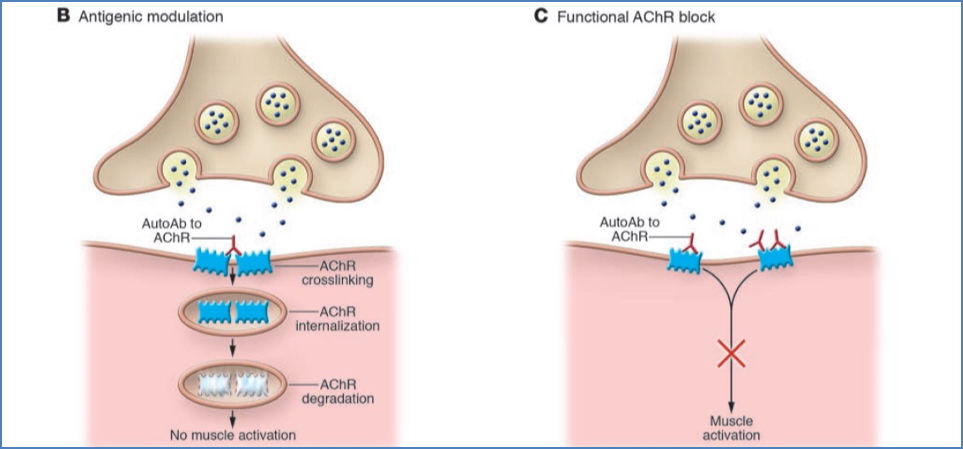 MYASTHENIA GRAVIS pathophysiology