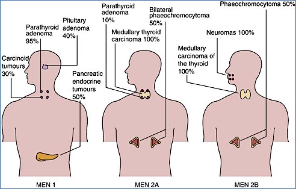 MULTIPE ENDOCRINE NEOPLASIA