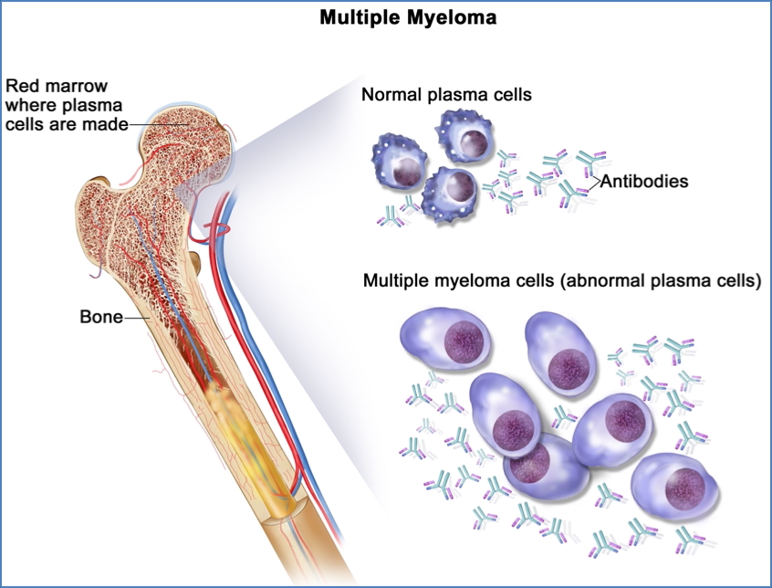 MULTIPLE MYELOMA