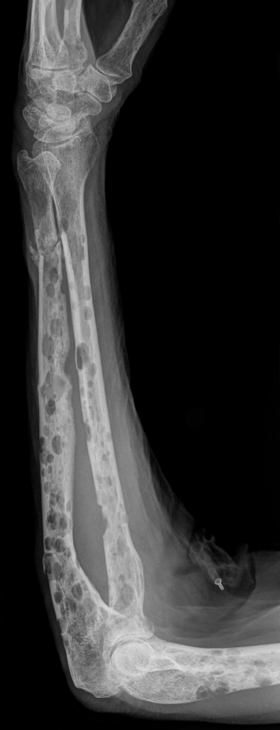 MULTIPLE MYELOMA xray