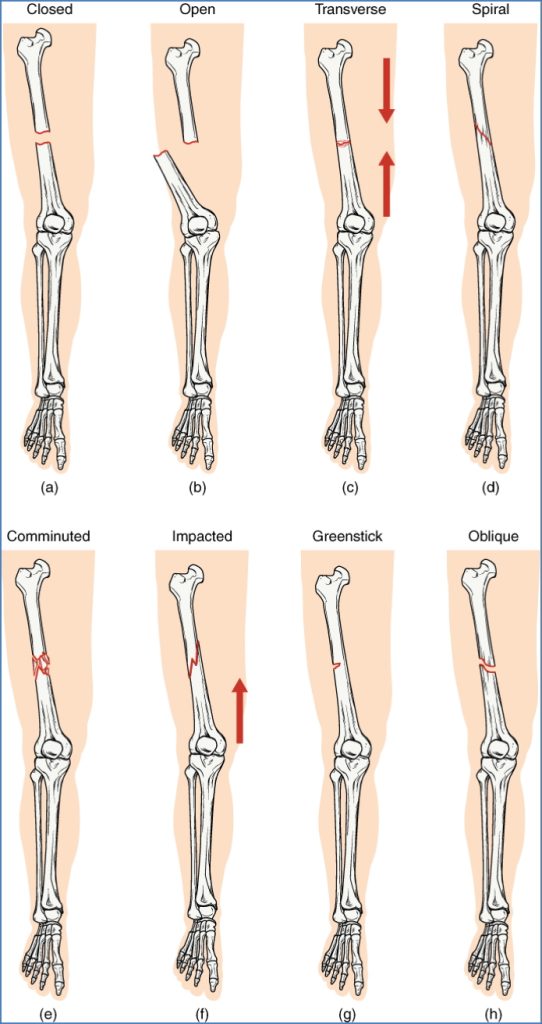 bony injuries - Morphology of Fractures
