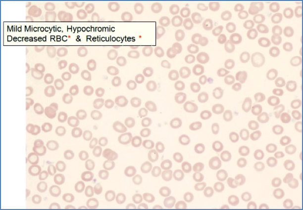 anaemia of chronic disease - Morphology