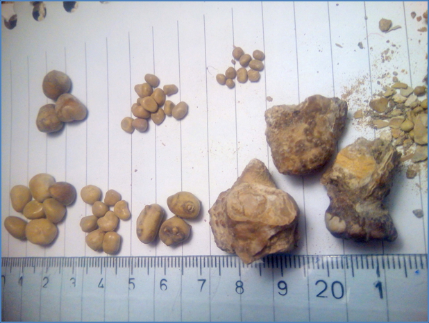 renal stones - NEPHROLITHIASIS