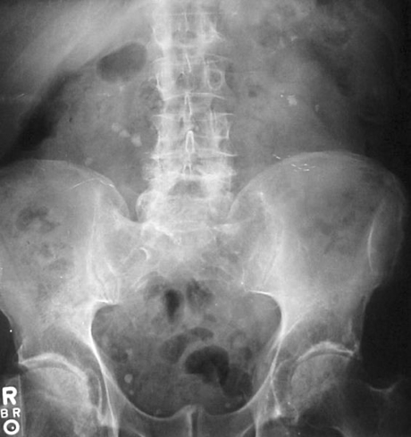 renal stones - Xray