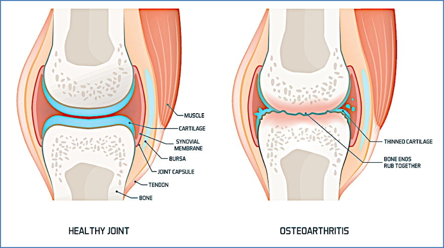 OSTEOARTHRITIS