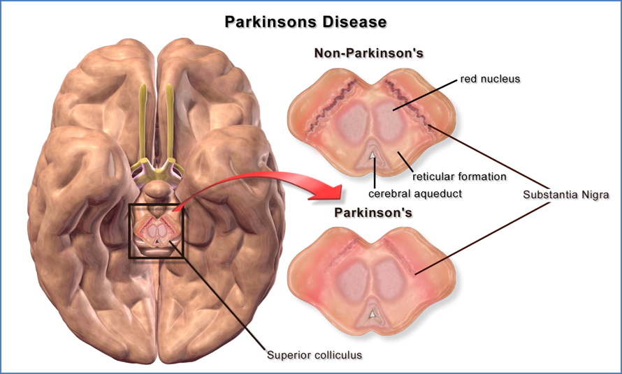 PARKINSON’S DISEASE
