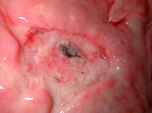 PEPTIC ULCER DISEASE