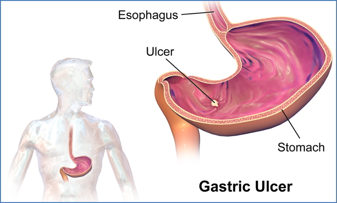 PEPTIC ULCER DISEASE
