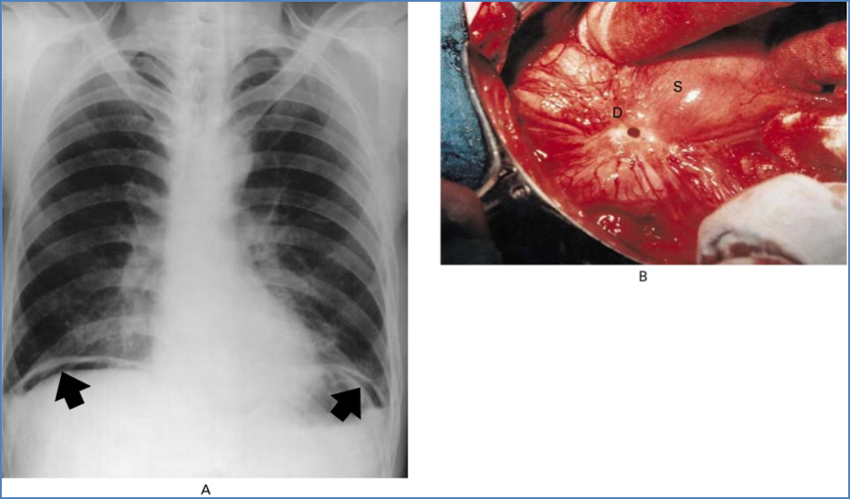 PEPTIC ULCER DISEASE