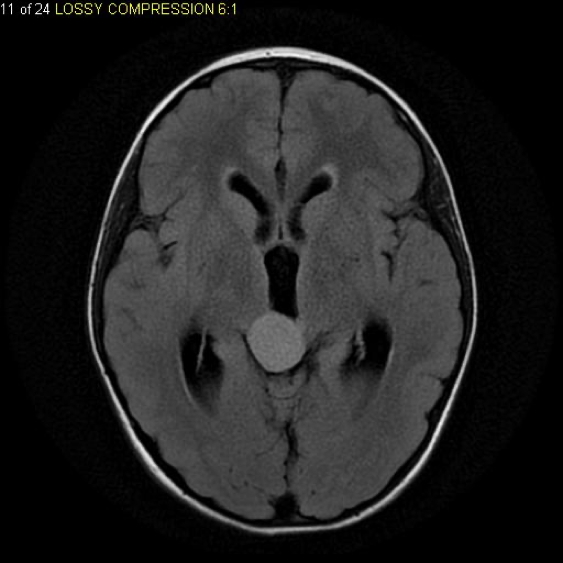 PILOCYTIC ASTROCYTOMAS