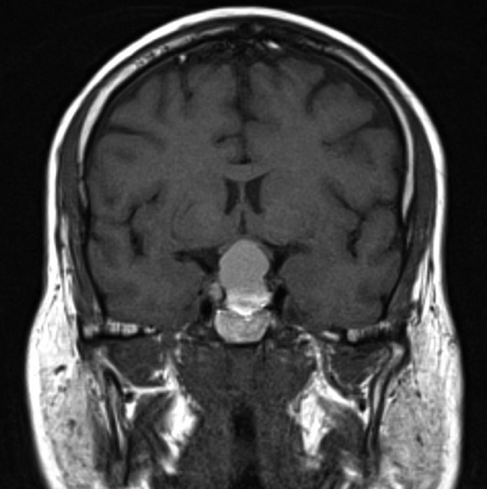 PITUITARY ADENOMAS