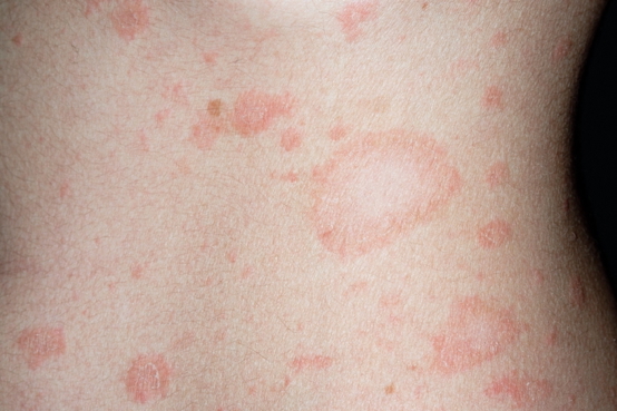 PITYRIASIS ROSEA