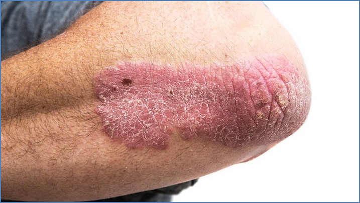 PSORIASIS