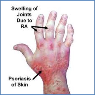 PSORIATIC ARTHRITIS