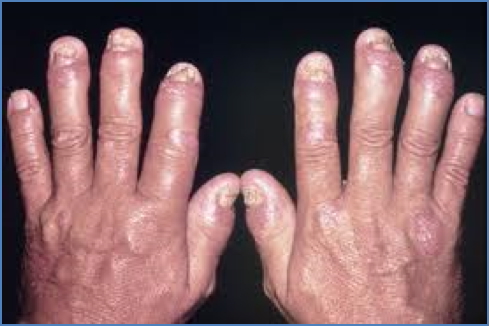 PSORIATIC ARTHRITIS