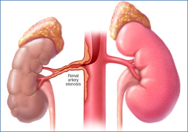 RENAL ARTERY STENOSIS