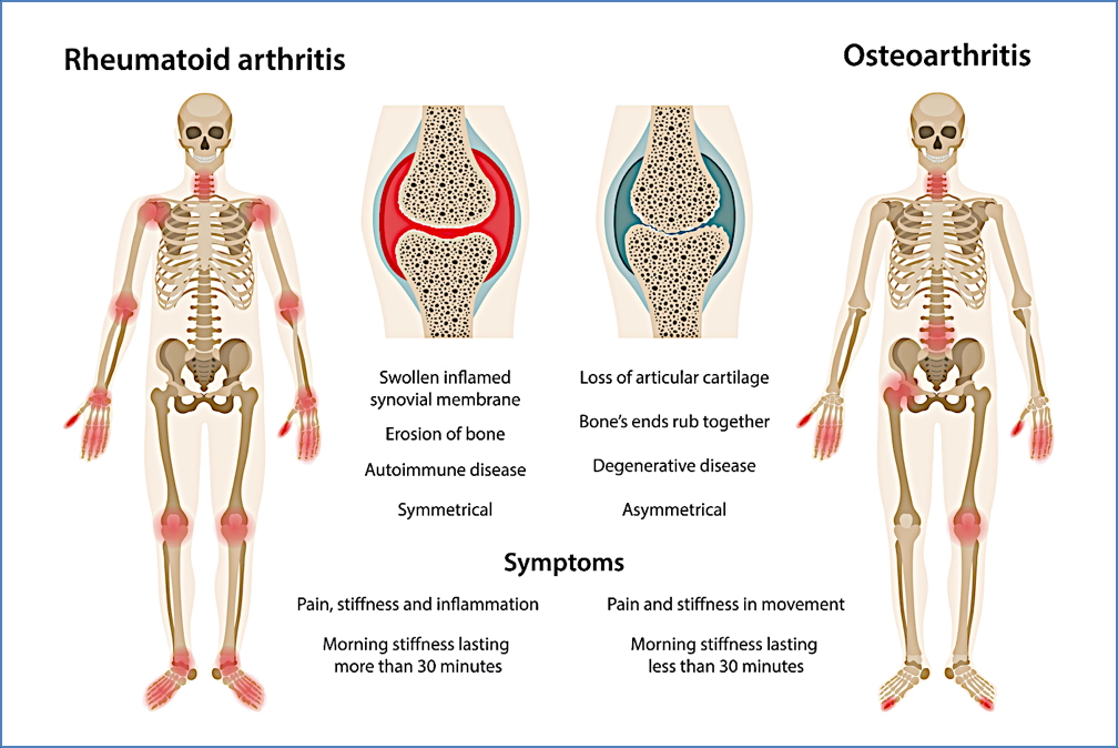 RHEUMATOID ARTHRITIS