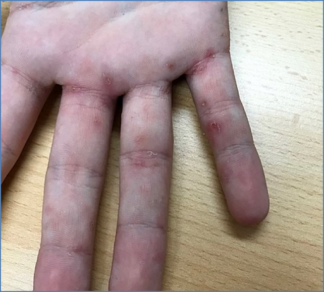 parasitic skin infestations - SCABIES