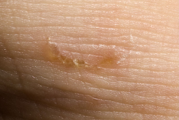 parasitic skin infestations - SCABIES